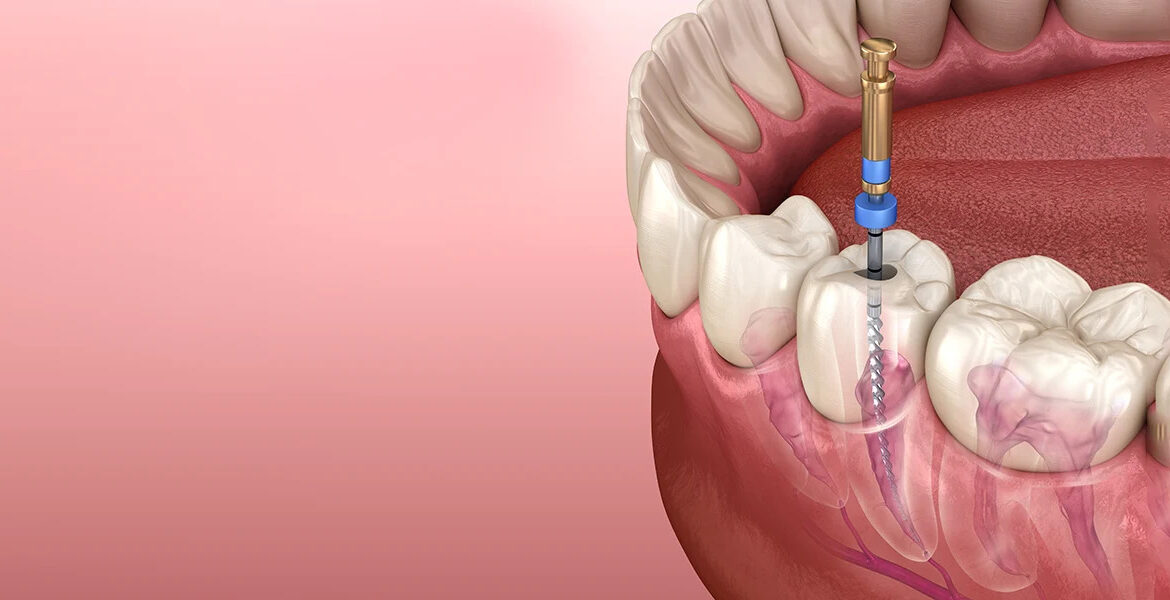 Advanced Root Canal Treatment In Thane