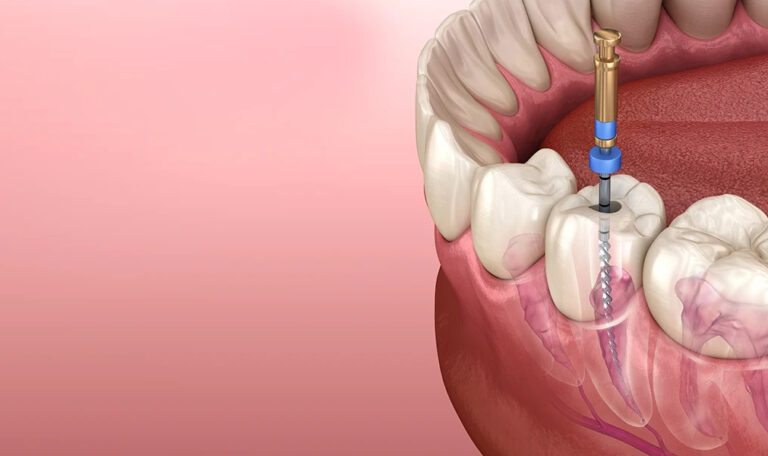Advanced Root Canal Treatment In Thane