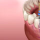 Advanced Root Canal Treatment In Thane